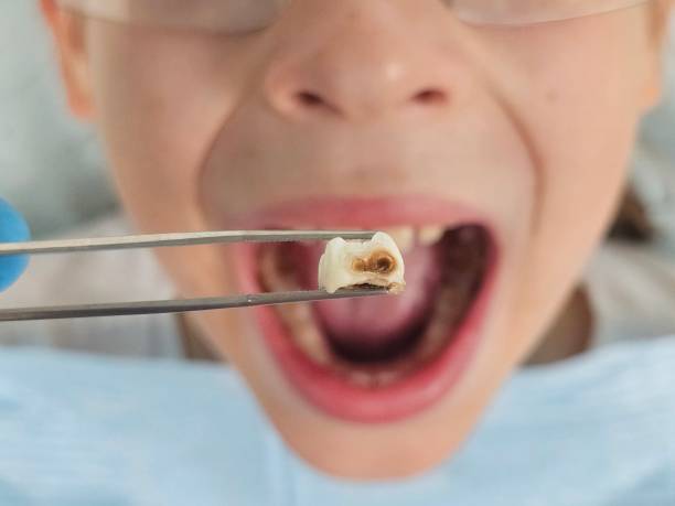 Best Emergency Broken Tooth Repair in Eerlin, ND